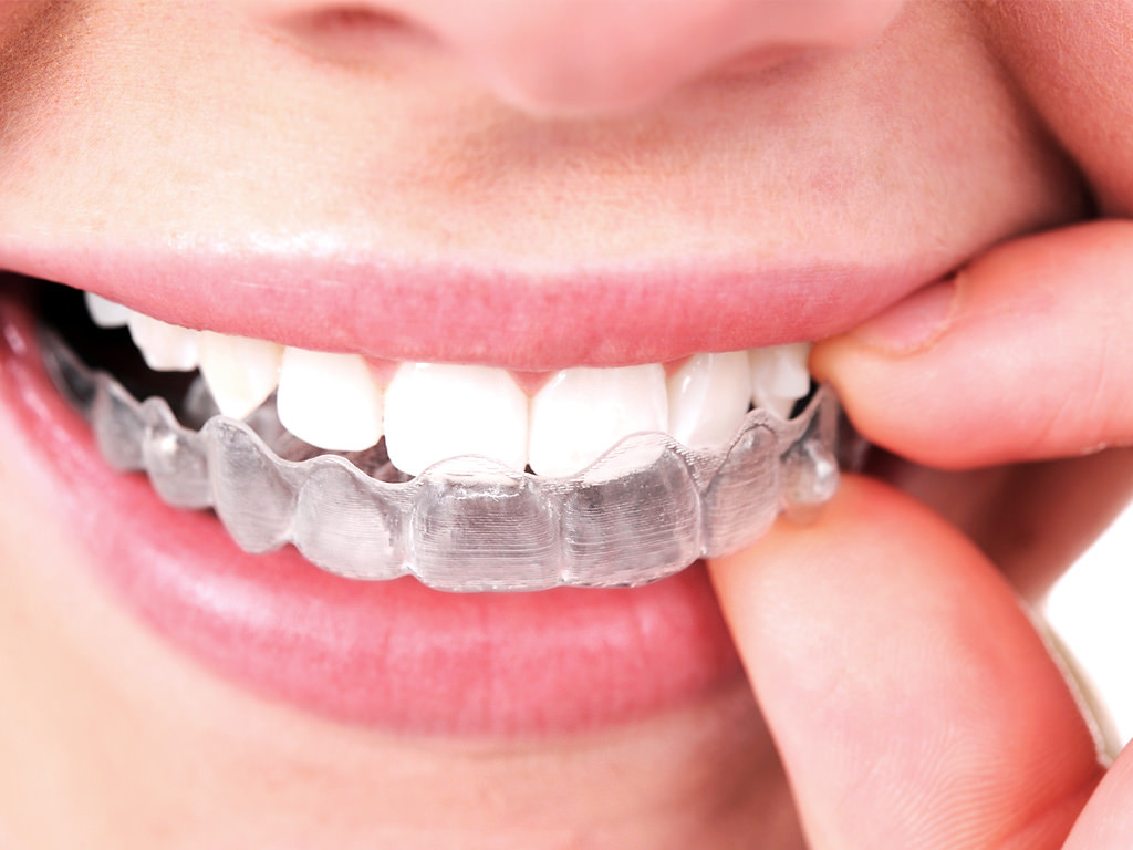 choosing invisalign to close gaps