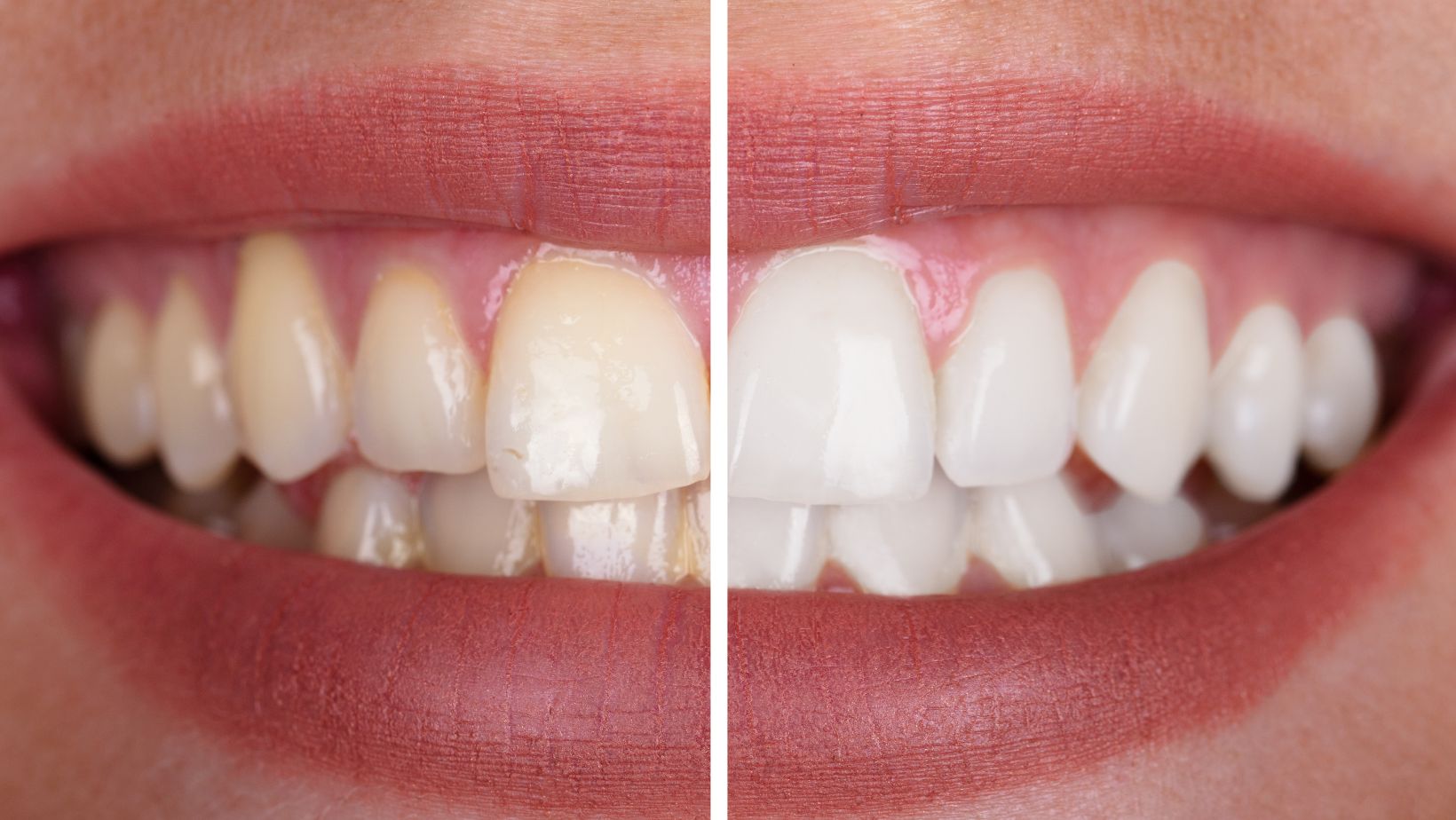 before and after images of teeth cleaned by a dentist