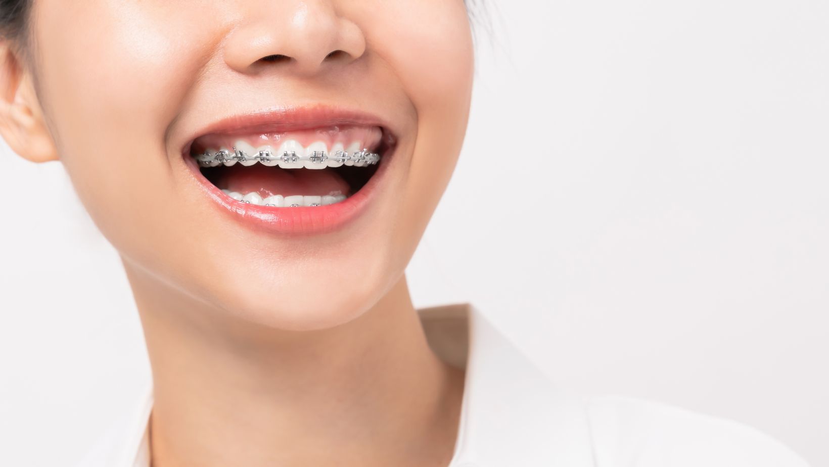 Can Braces Fix an Underbite?