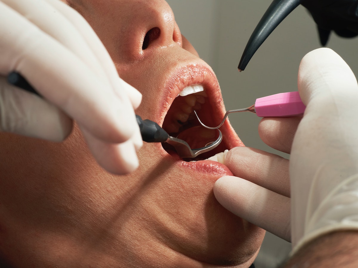 Close-up of a patient's mouth as a dentist prepares for a temporary filling