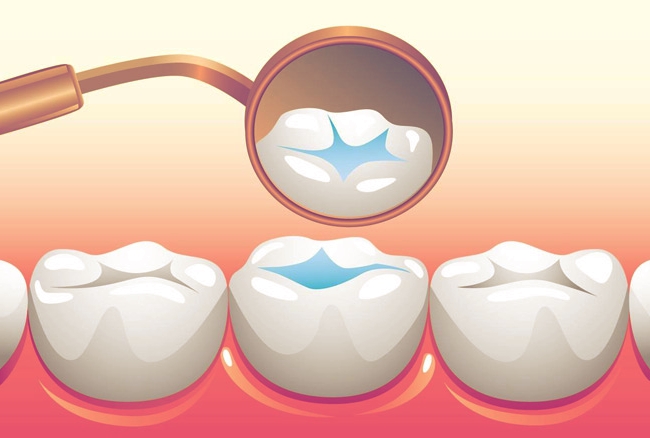 Sealants Wearing Out? Is That a Thing?