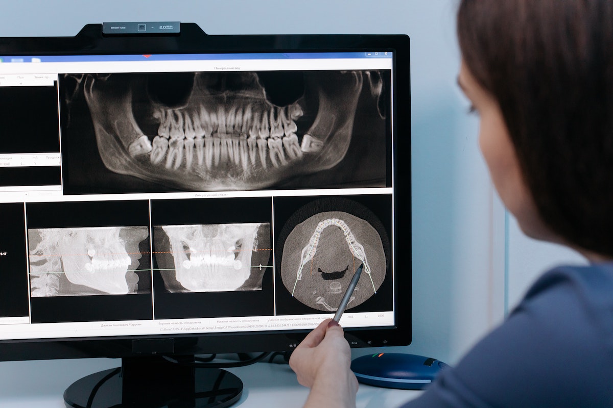 Dentist studying results of dental x-ray for signs of a cavity under a dental crown