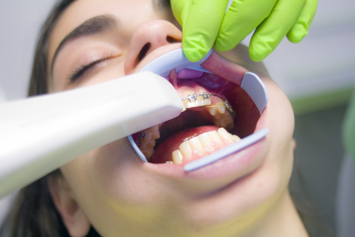 Getting braces to fix crooked permanent teeth