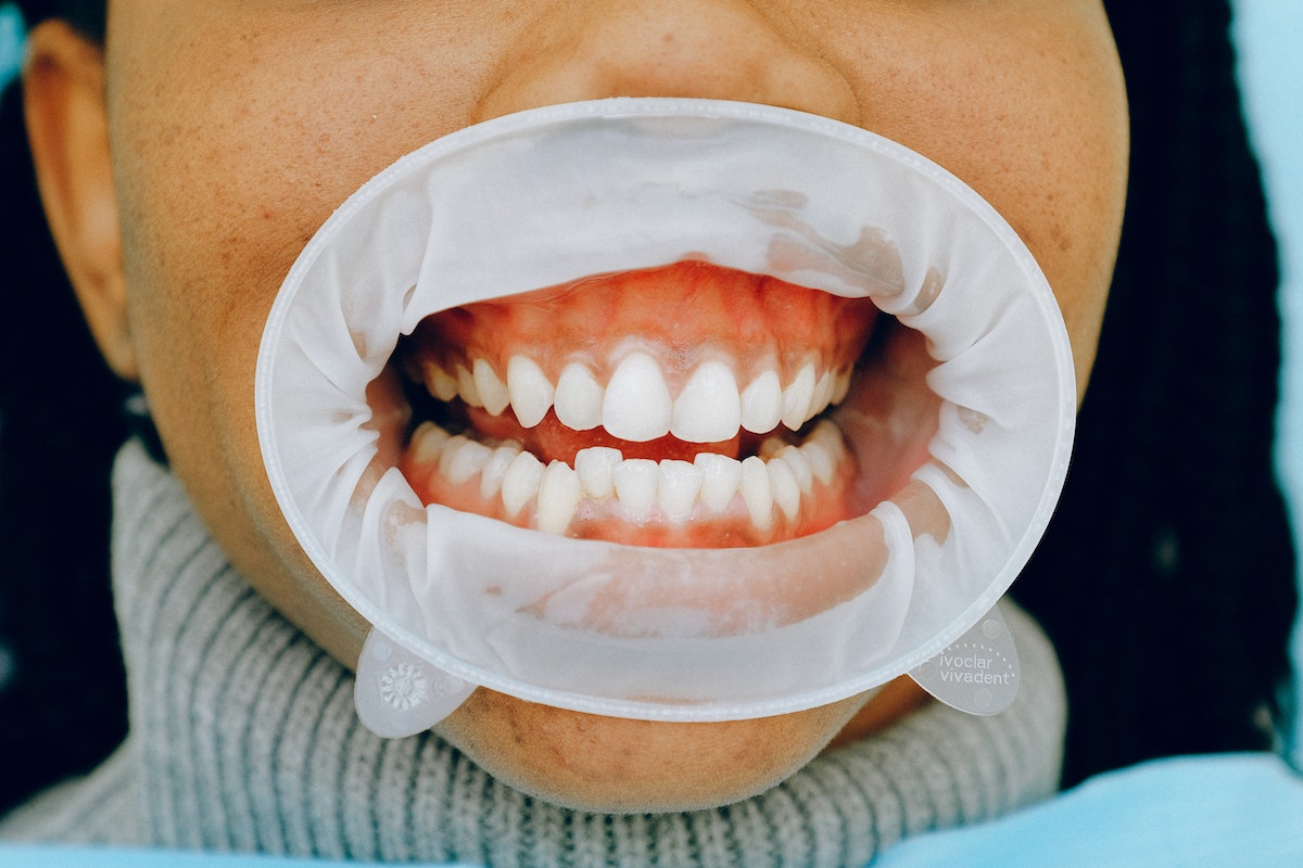 Person with dental cheek retractor so dentist can check for signs of gum disease