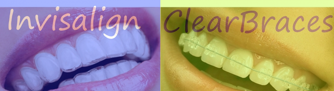 Clear Braces vs. Invisalign: Differences, Options, and Prices