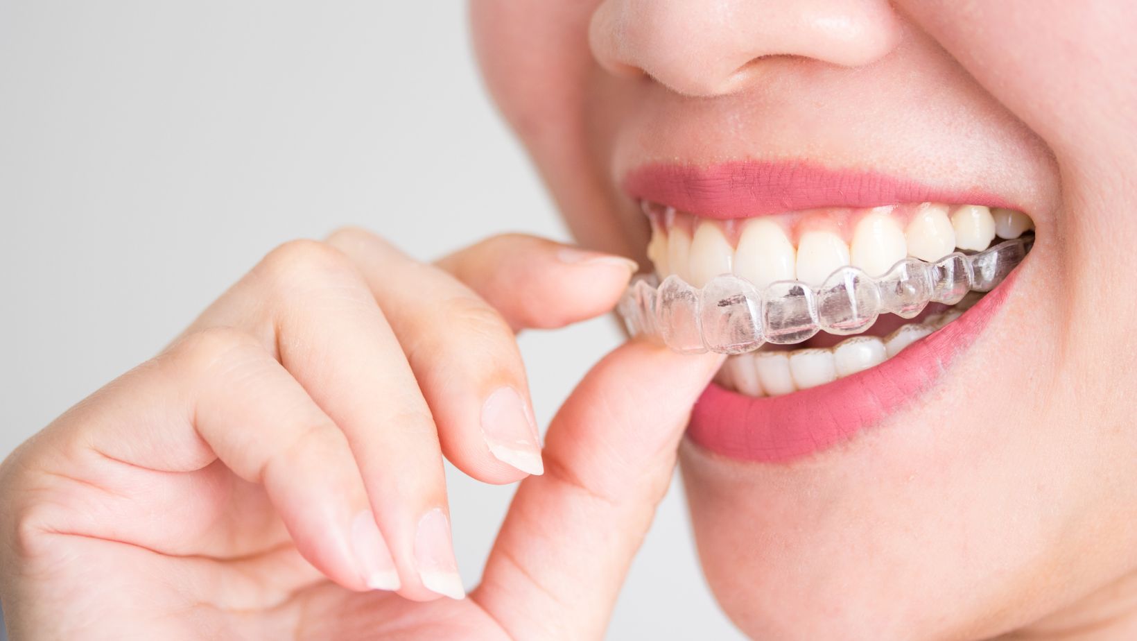 Shaving Teeth for Invisalign