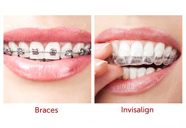 How does Invisalign work