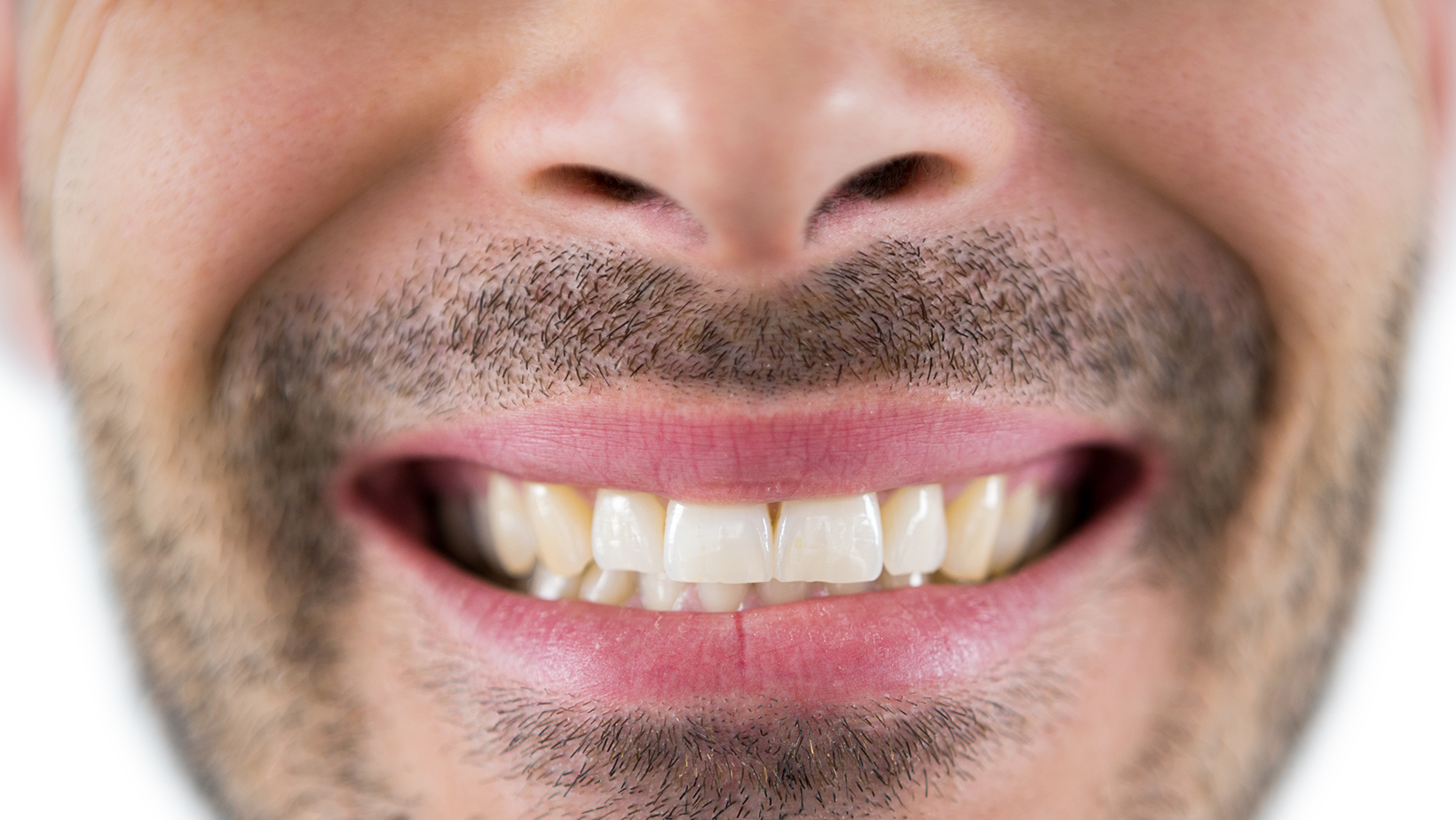 Hairline Cracks in Teeth: What are They? And Other Frequently Asked Questions