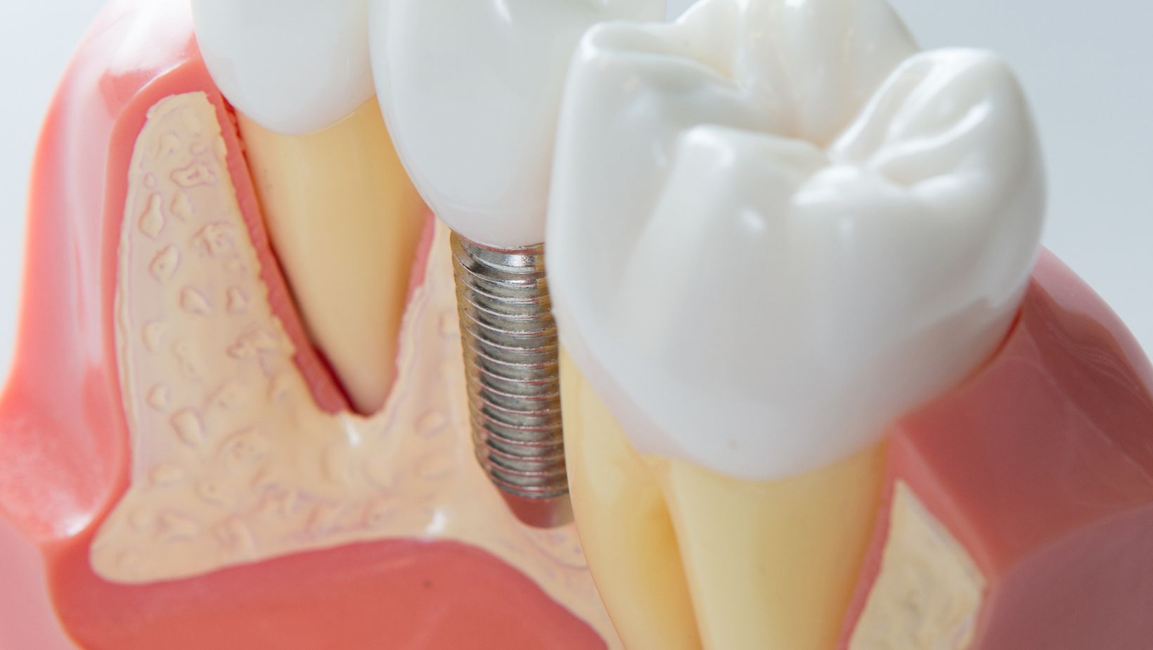 Are Dental Implants Safe?