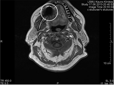 mri artifact caused by metal dental crown