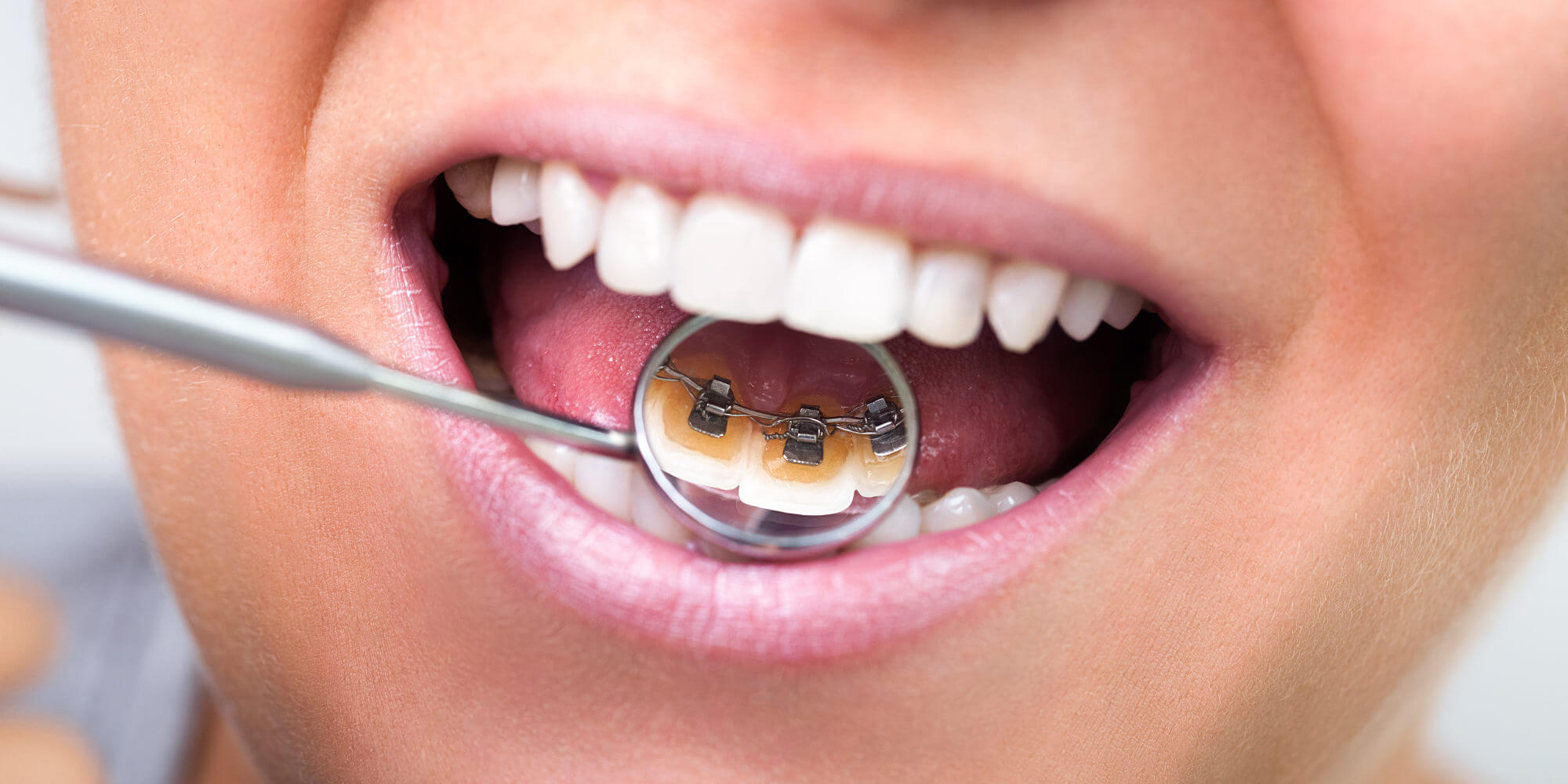 dentist using mirror to show lingual braces