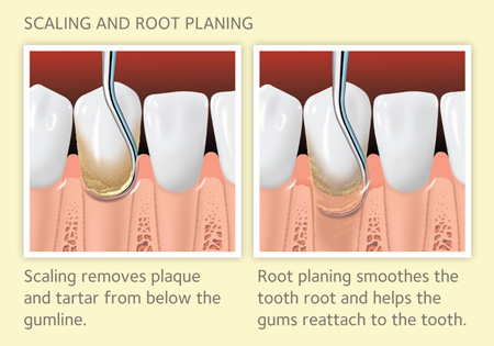 scaling and root planing diagram from the ADA