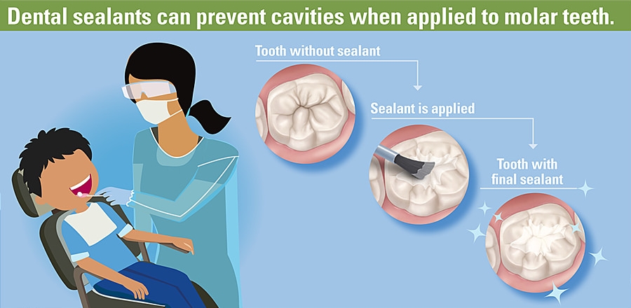 Diagram showing the process of getting dental sealants