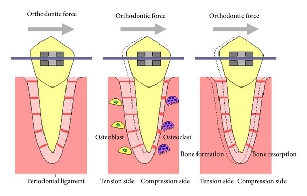 How braces work