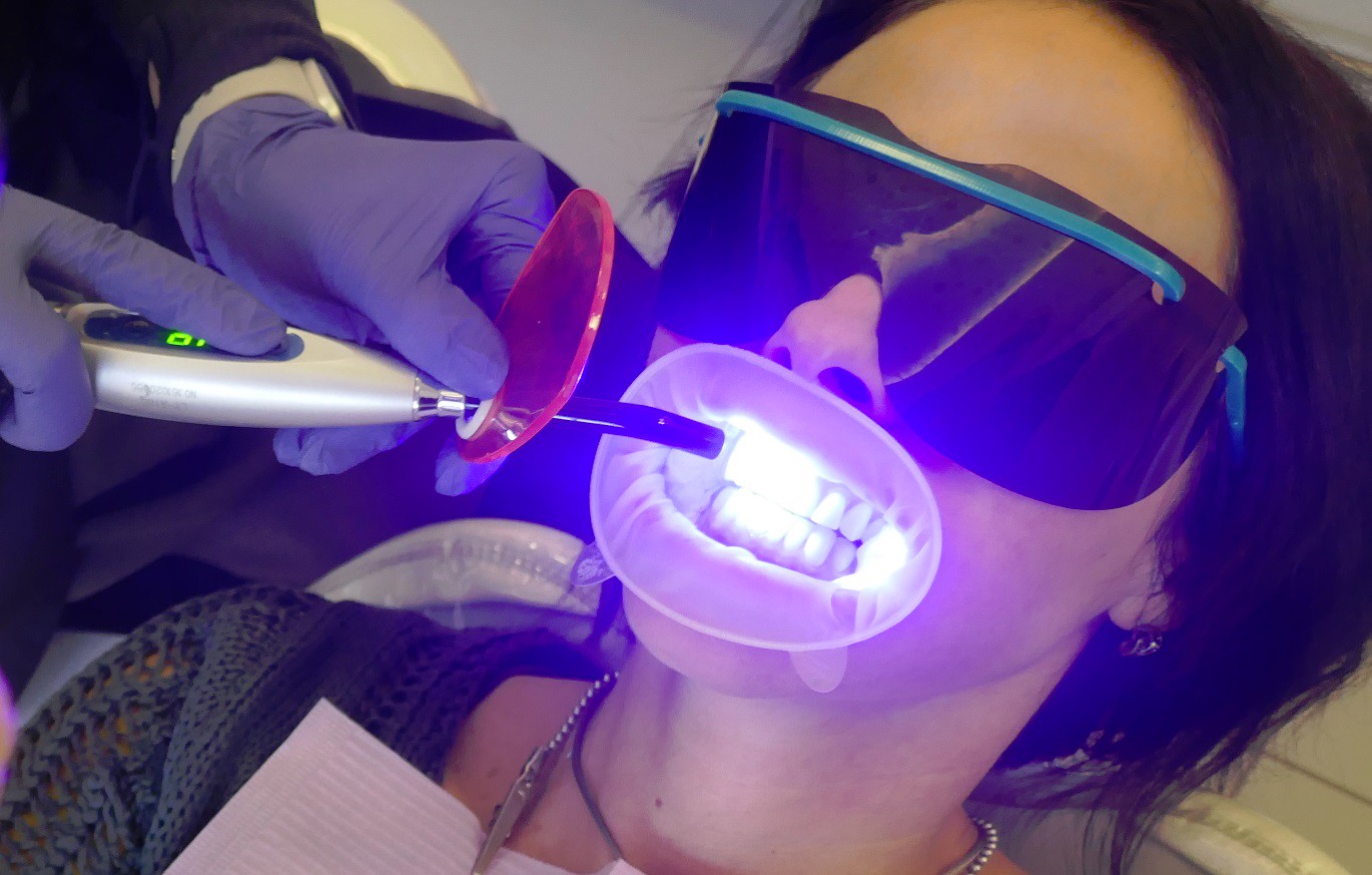 woman doing teeth whitening procedure while pregnant