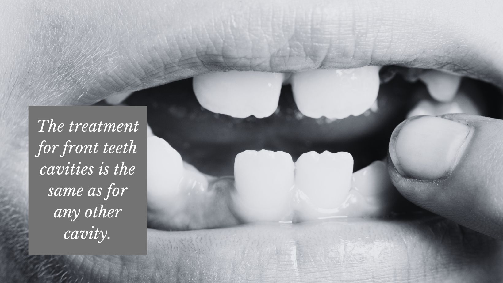 dental patient receiving treatment for front teeth cavities