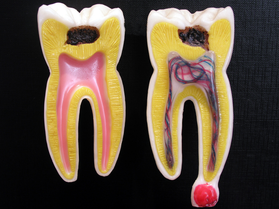 How Does Dental Pulp Get Infected?