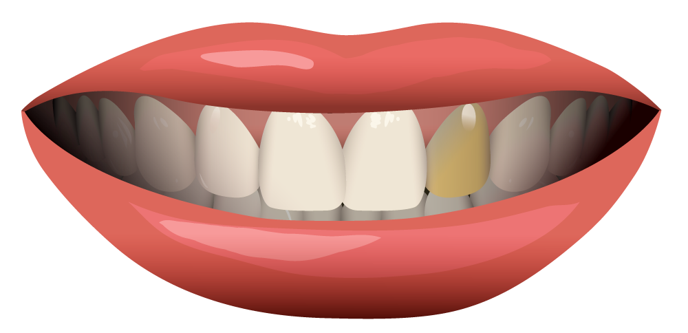 Can Dental Crowns Be Whitened?