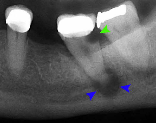 x-ray showing a dental abscess around the root of a tooth